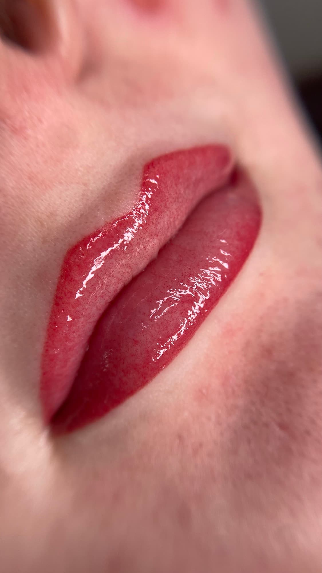 Resultaat van een lipbehandeling.